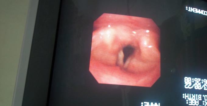 Activités de bronchoscopie